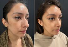 before and after female rhinoplasty Murray Hill Plastic Surgery right angle view case 28919