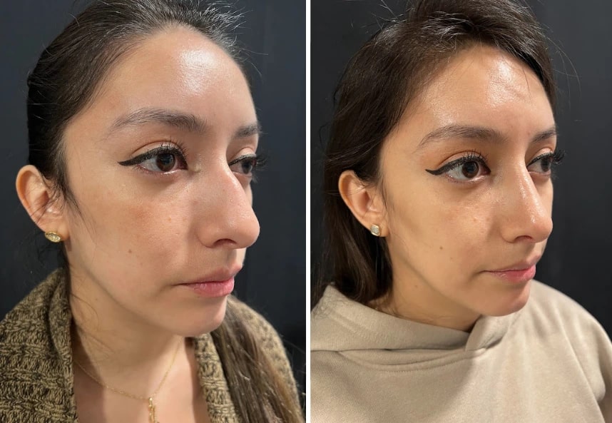 before and after female rhinoplasty Murray Hill Plastic Surgery right angle view case 28919