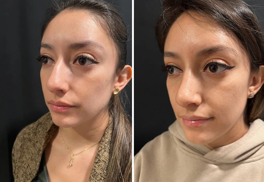 before and after female rhinoplasty Murray Hill Plastic Surgery left angle view case 28919