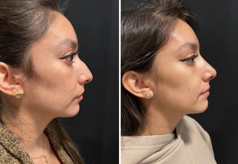 before and after female rhinoplasty Murray Hill Plastic Surgery case 28919