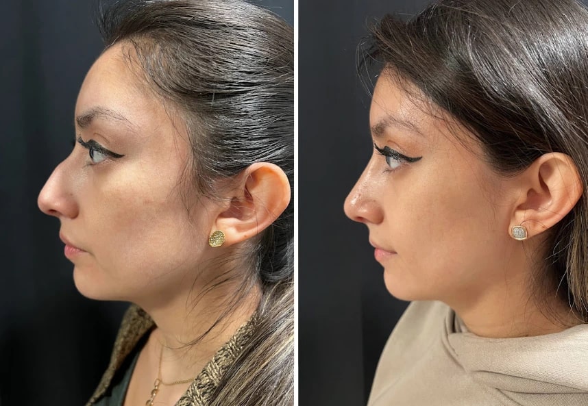 before and after female rhinoplasty Murray Hill Plastic Surgery left sideview case 28919