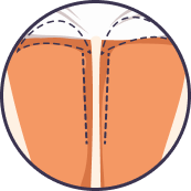 thigh lift image