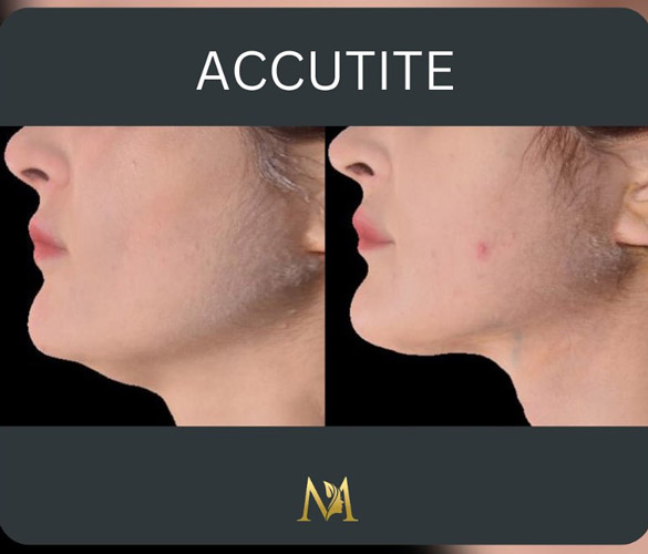 before and after Accutite non-surgical facial contouring NYC
