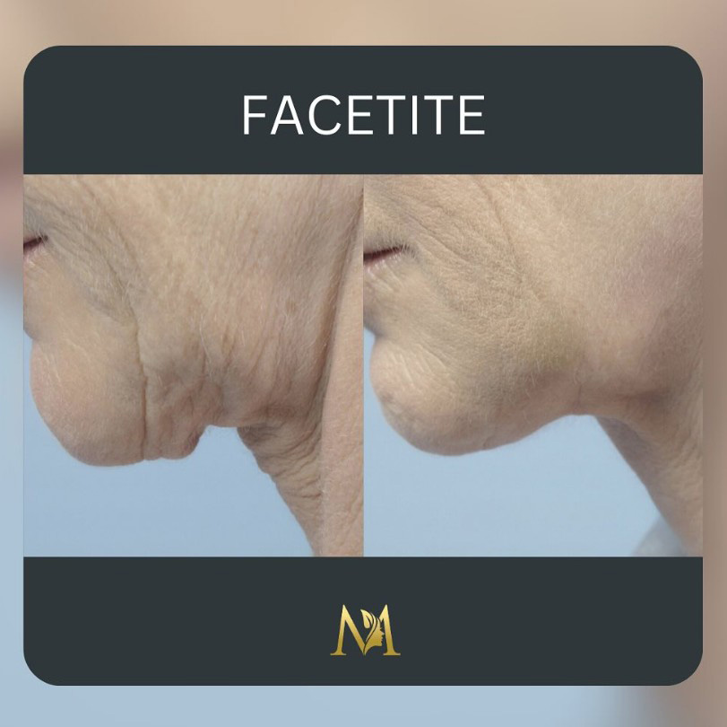 Before and after non-surgical neck contouring Murray Hill Plastic Surgery