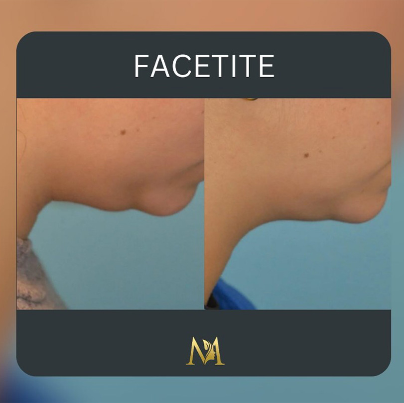 before and after non-surgical face contouring NYC Murray Hill Plastic Surgery