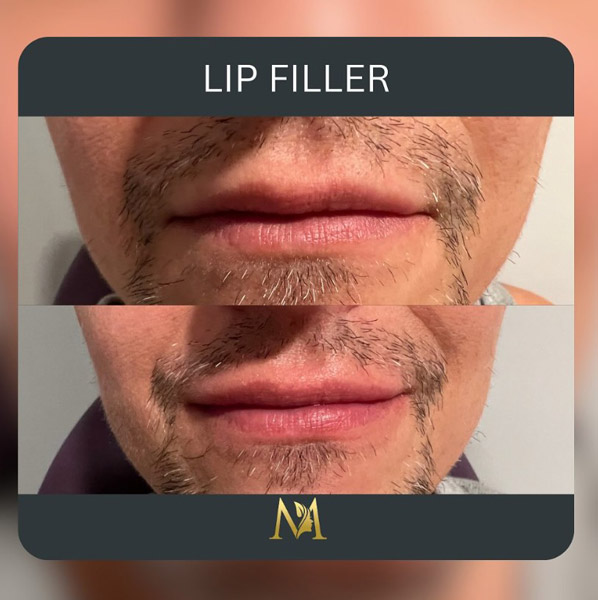 Before and after lip filler NYC male patient