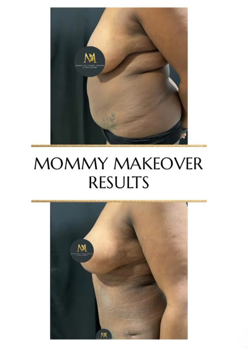 before and after mommy makeover results Murray Hill Plastic Surgery