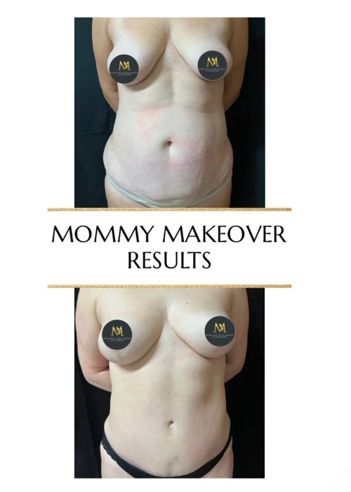 before and after mommy makeover with breast lift NYC