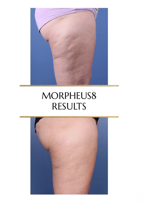 before and after cellulite treatment on thighs with morpheus8