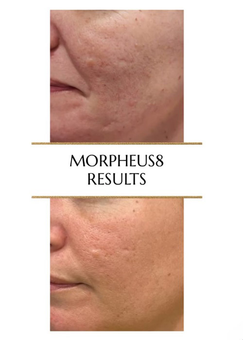 before and after skin rejuvenation with morpheus8 NYC Murray Hill Plastic Surgery