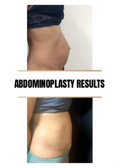 before and after tummy tuck NYC at Murray Hill Plastic Surgery