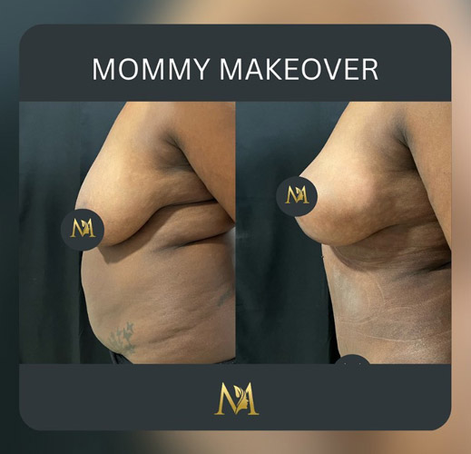 mommy makeover before and after NYC Dr. Sabry