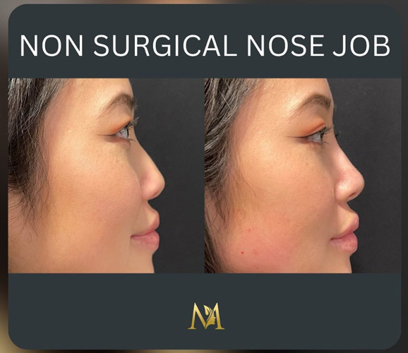 non-surgical nose job NYC Murray Hill Plastic Surgery