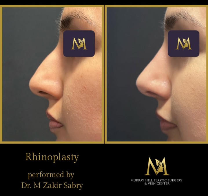 before and after rhinoplasty performed by Dr. M Zakir Sabry