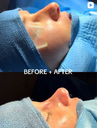 Before and after septorhinoplasty