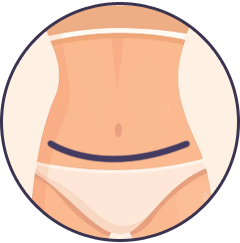 tummy tuck image