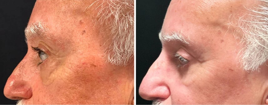 before and after male blepharoplasty Dr. Sabry left side view case 30143