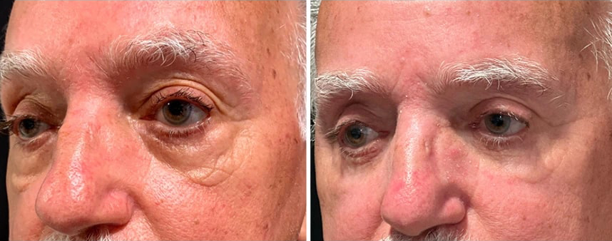 before and after male blepharoplasty Dr. Sabry left angle view case 30143
