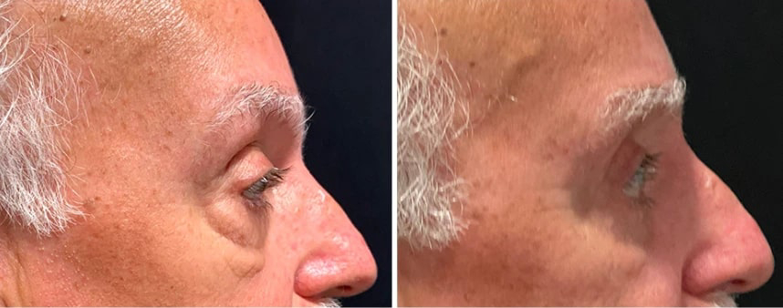 before and after male blepharoplasty Dr. Sabry side view case 30143