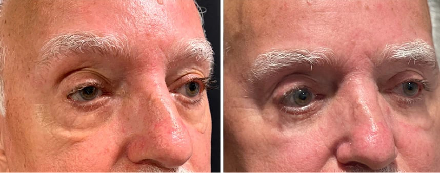 before and after male blepharoplasty Dr. Sabry angle view case 30143