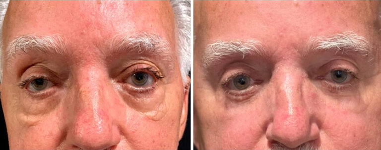 before and after male blepharoplasty Dr. Sabry front view case 30143