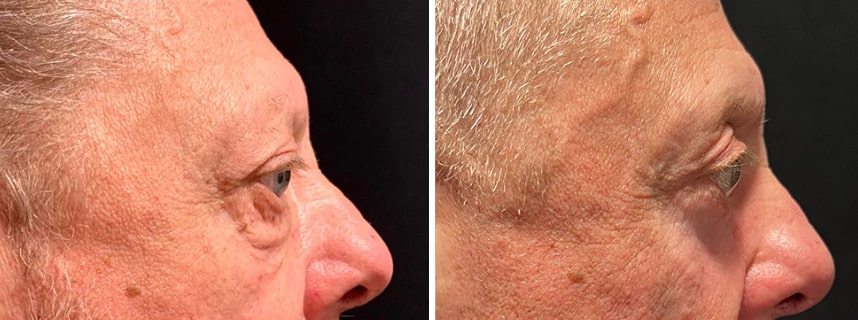 before and after male blepharoplasty NYC side view case 30149