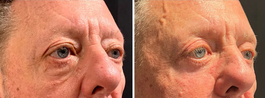 before and after male blepharoplasty NYC angle view case 30149