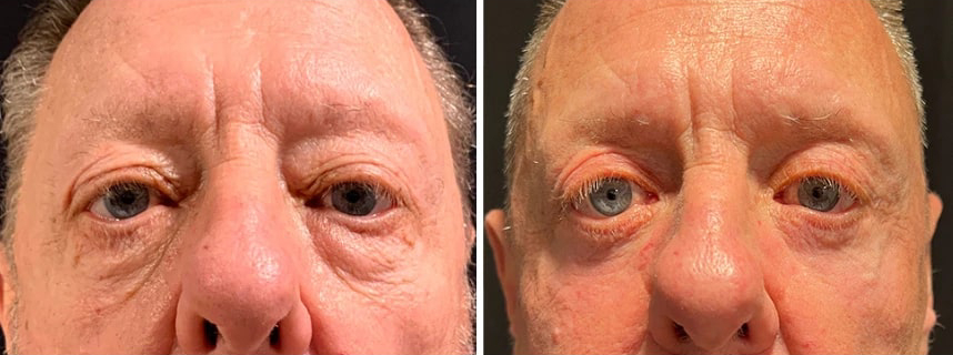 before and after male blepharoplasty NYC front view case 30149