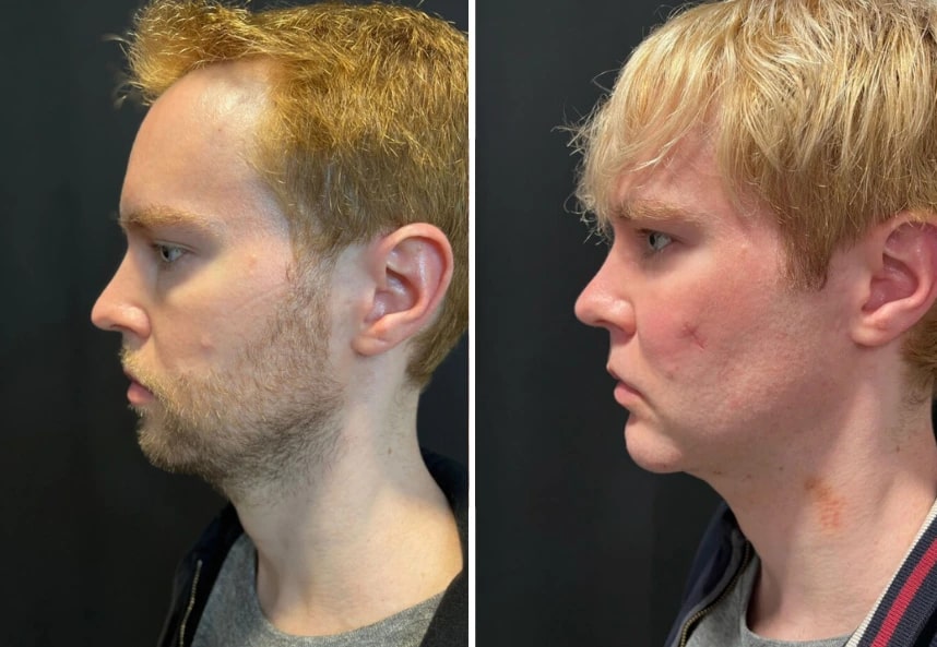 before and after male facelift Dr. Sabry left side view case 30137