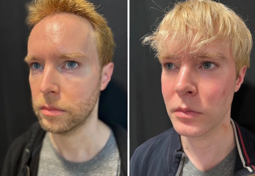 before and after male facelift Dr. Sabry left angle view case 30137