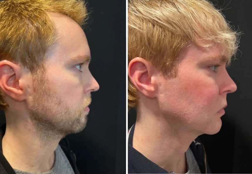 before and after male facelift Dr. Sabry right side view case 30137