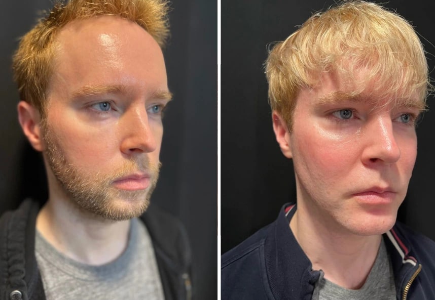 before and after male facelift Dr. Sabry right angle view case 30137