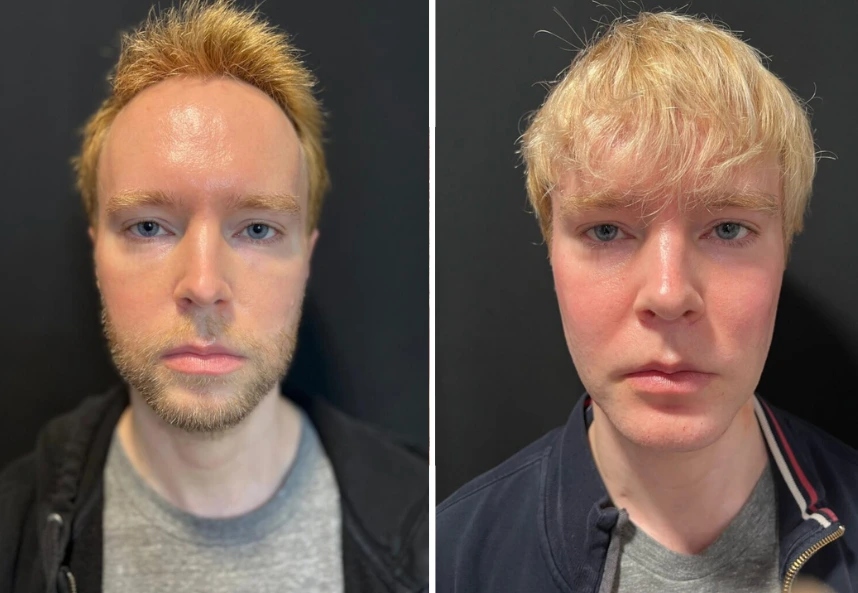 before and after male facelift Dr. Sabry front view case 30137