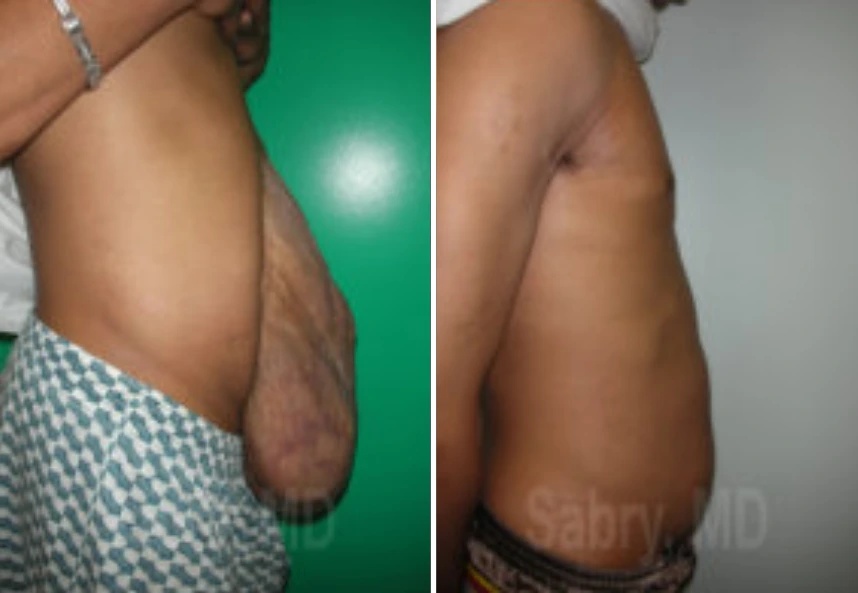 before and after male hernia correction side view case 30168