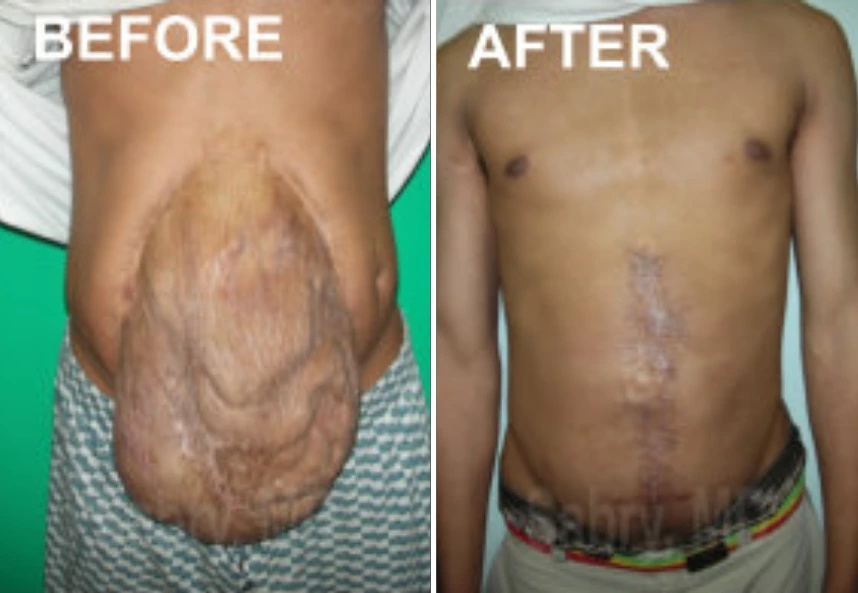 before and after male hernia correction front view case 30168