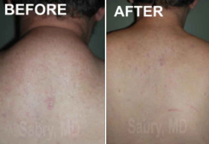 before and after buffalo hump liposuction NYC male patient back view case 30161