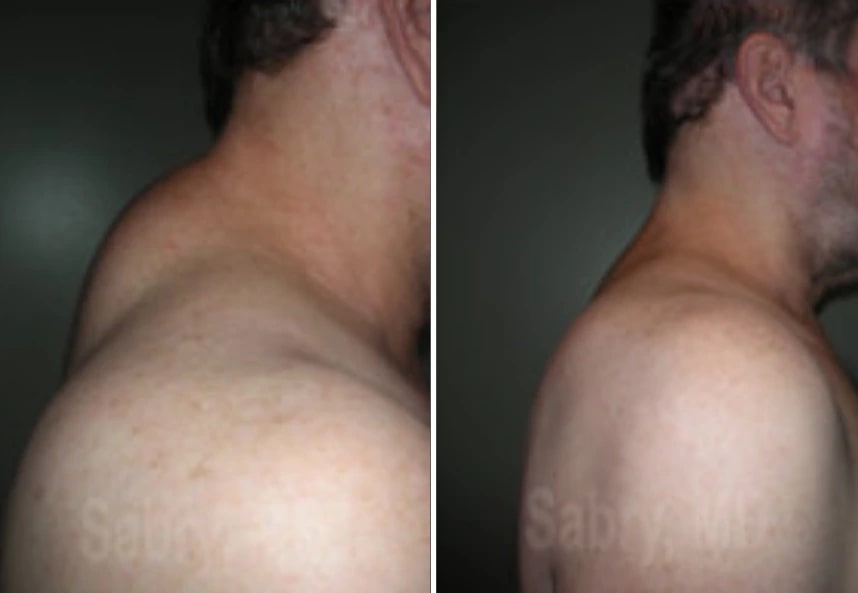 before and after buffalo hump liposuction NYC male patient side view case 30161