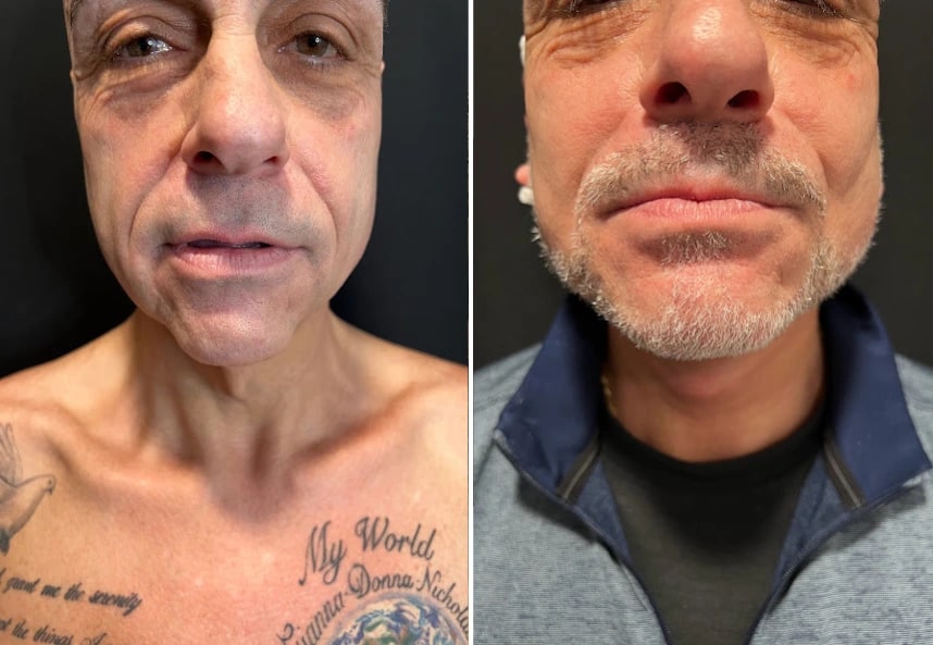 before and after male neck lift front view case 30129
