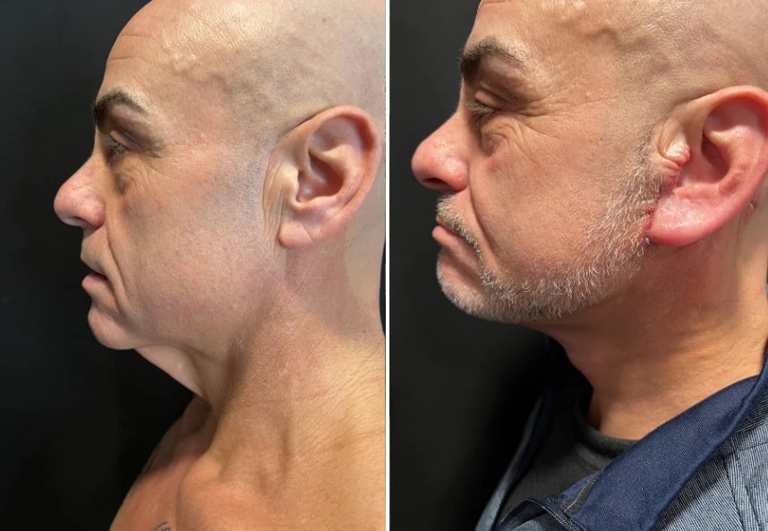 before and after male neck lift right side view case 30129
