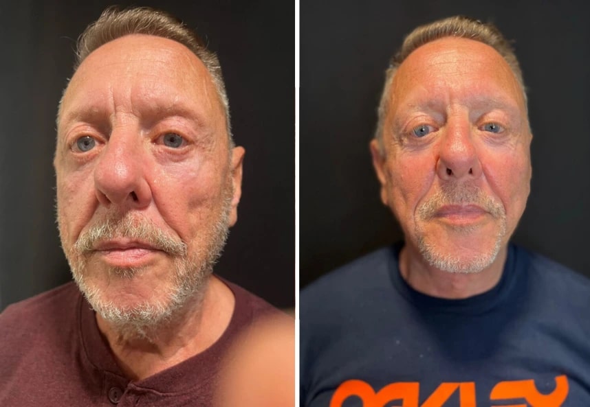 before and after male neck lift NYC front view case 30132