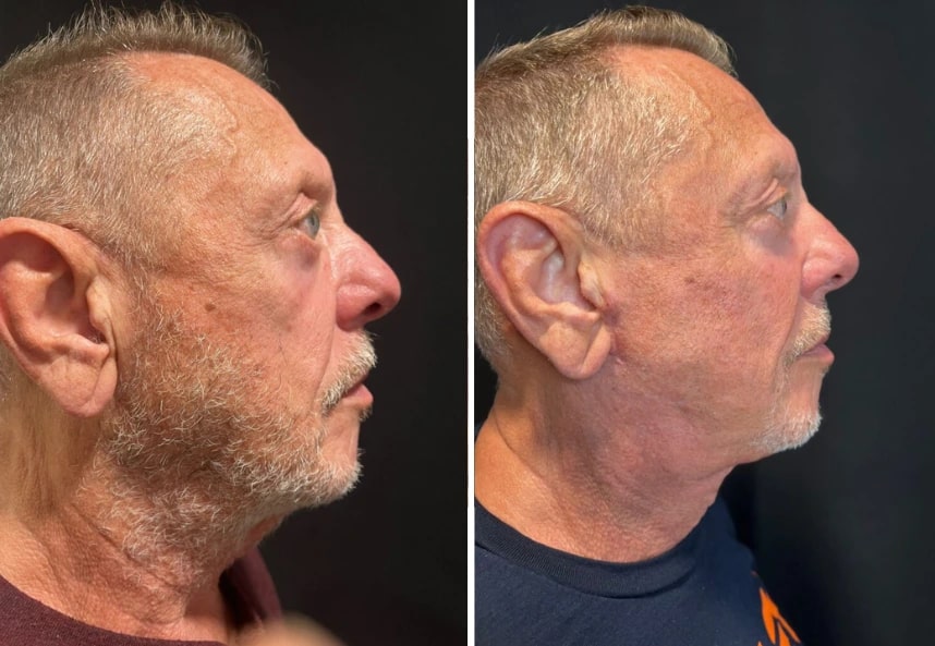 before and after male neck lift NYC right side view case 30132