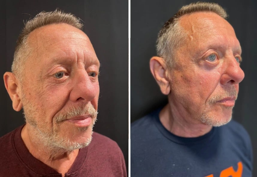 before and after male neck lift NYC right angle view case 30132