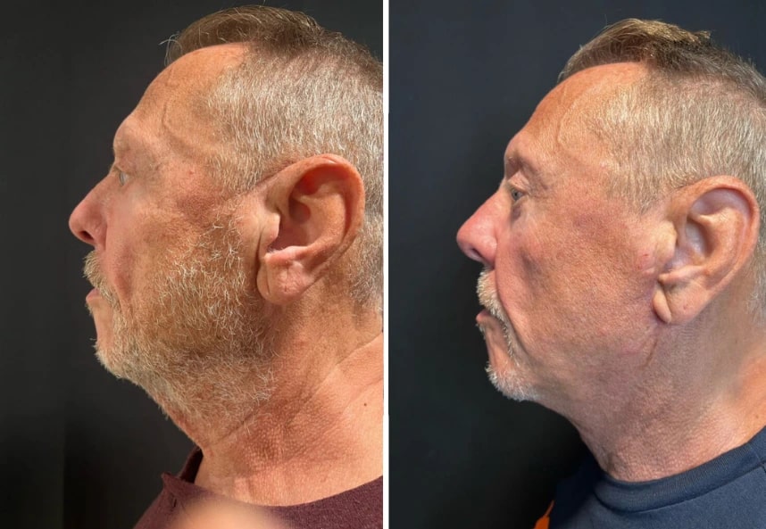 before and after male neck lift NYC left side view case 30132