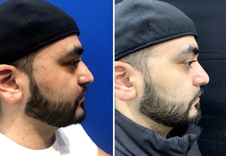 before and after male rhinoplasty NYC side view case 30154