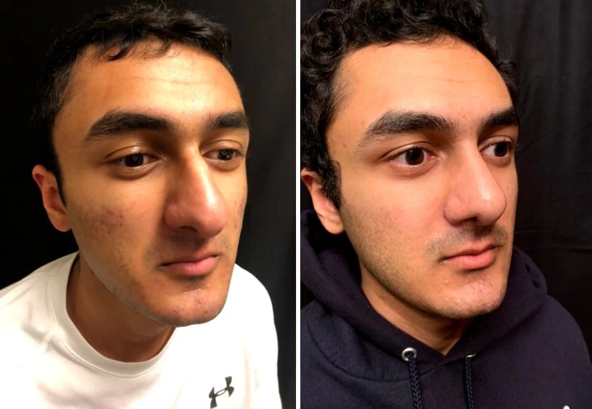 before and after male rhinoplasty NYC angle view case 30156