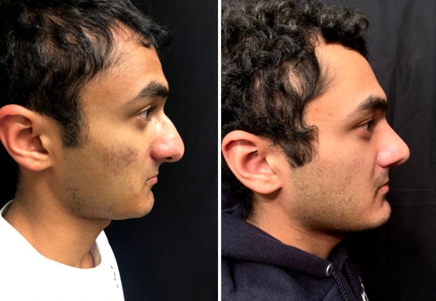 before and after male rhinoplasty NYC side view case 30156