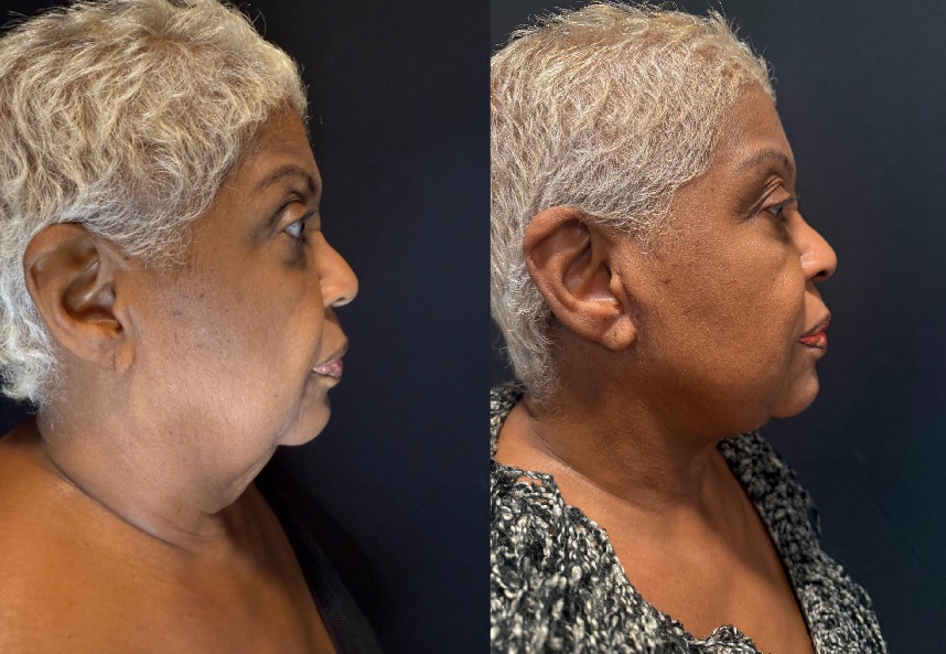 before and after necklift NYC female patient right side view case 31387
