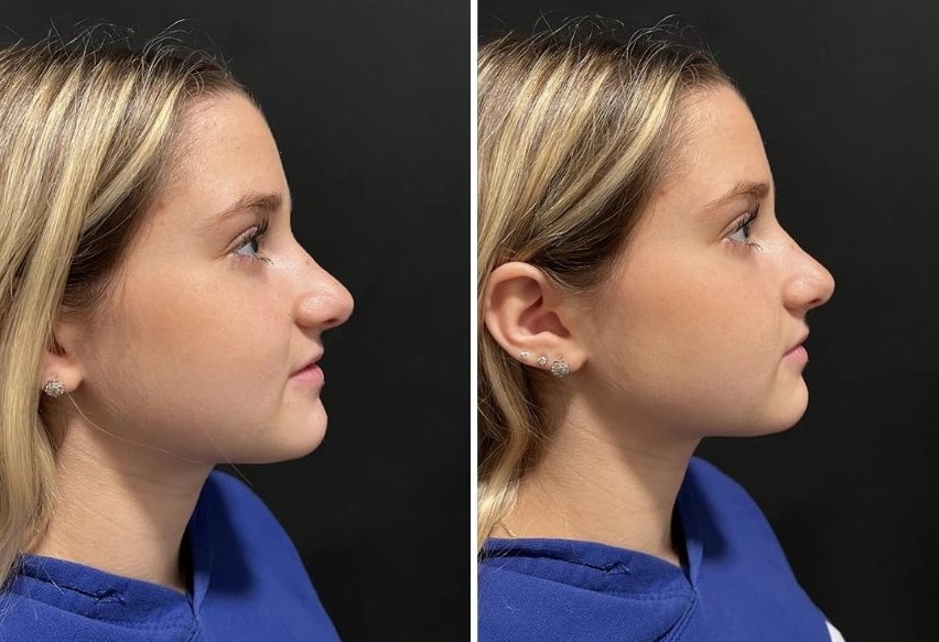 before and after revision rhinoplasty NYC