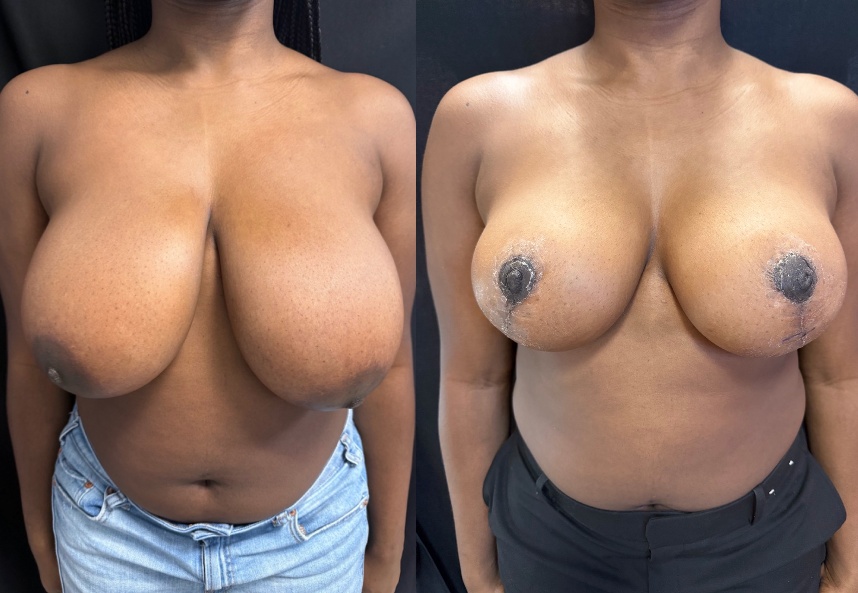 before and after breast reduction NYC front view case 33471