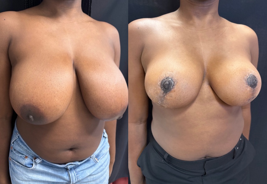 before and after breast reduction NYC right angle view case 33471